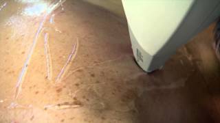 Lightsheer Laser Hair Removal [upl. by Noed]