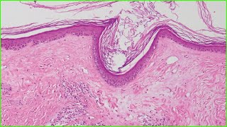 Lichen Sclerosus 🩺Treatment 🩺Symptoms 🩺Causes📰 [upl. by Edrick]