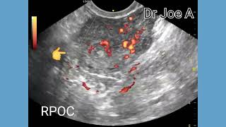 RPOC or retained products of conception incomplete abortion ultrasound color spectral Doppler [upl. by Featherstone]