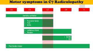 C7 Radiculopathy [upl. by Alyhc]