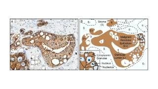 XMRV a New Human Retrovirus Lecture 25 [upl. by Nerag]