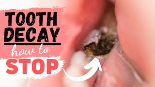 Tooth Decay Treatment for a Tooth Cavity [upl. by Nyved]