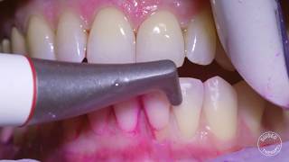 How teeth should be cleaned at the Dentist  Hygienist [upl. by Lopes]