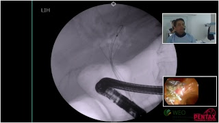 Intrahepatic biliary tract dilation [upl. by Meaghan]