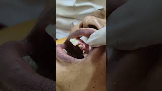 post ampcore gingivectomycrown cutting maxillary tooth [upl. by Lipcombe342]