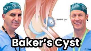 Understanding and Treating Bakers Cyst [upl. by Solrac642]