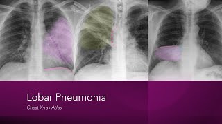 Lobar Pneumonia Chest Xray Atlas [upl. by Niuqauj408]