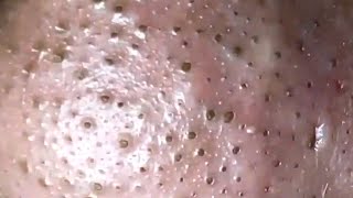 Blackheads amp Whiteheads Satisfying Removal 0004 [upl. by Marleen993]