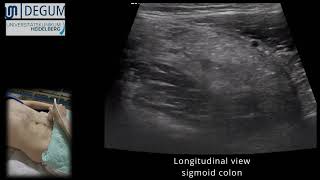 Episode 25 Epiploic Appendagitis [upl. by Atat]