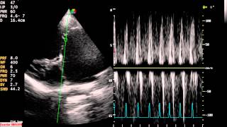 DISPLASIA DE VALVULA MITRAL [upl. by Flavian]