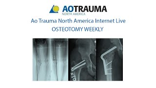 Osteotomy Week 7 May 30 Periarticular Osteotomies around the knee [upl. by Joshua880]