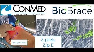 Ziptek Zip E Biorez Interpositional Collagen Graft [upl. by Ced]