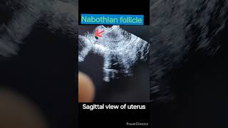 Nabothian follicle in cervix cervix cervicitisultrasound sonography doctor [upl. by Kiley]