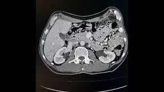 Scirrhous carcinoma of stomach [upl. by Weikert48]