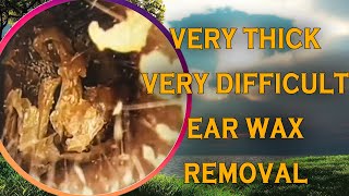 Very thick ear wax removal  Very difficult to removed  DR SEYLA [upl. by Anauqed]