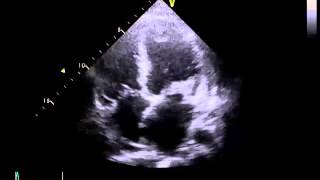 Echocardiography to Assess MitralValve Leaflets  NEJM [upl. by Krista998]