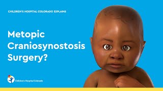 What is Metopic Craniosynostosis Surgery [upl. by Ainwat273]