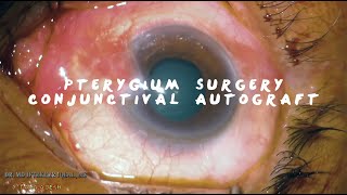 MIIQ 97 Pterygium Surgery Conjunctival Autograft with Sutures  DR MD IFTEKHER IQBAL RAJU [upl. by Terrye]