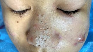 Big Cystic Acne Blackheads Extraction Blackheads amp Milia Whiteheads Removal Pimple Popping  4570 [upl. by Atsylac]