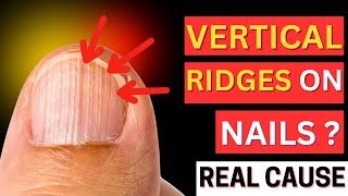 Thats The REAL Cause of VERTICAL RIDGES On Your Nails [upl. by Ynnam]