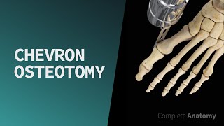 Chevron Osteotomy [upl. by Ennaerb329]