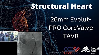 26mm EvolutPRO CoreValve TAVR  March 13 2018 [upl. by Attekahs]