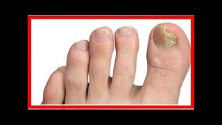 Comment prévenir les mycoses des ongles de pieds [upl. by Lindsay]