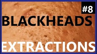 BLACKHEADS EXTRACTIONS on Happy  8 [upl. by Neiman]