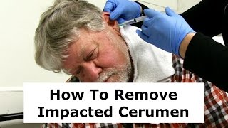 Removing Impacted Cerumen from a Patients Ear [upl. by Enrobyalc]