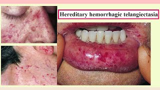 hereditary hemorrhagic telangiectasia [upl. by Noraed750]