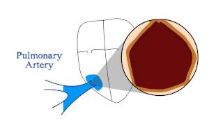 Pulmonary Stenosis [upl. by Hgielar]