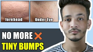 Get Rid Of Tiny Bumps On Face  Best Treatment For Tiny Bumps 100 Working [upl. by Eikcin965]