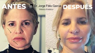 HILOS TENSORES ANTES Y DESPUÉS HILOS TENSORES FACIAL ANTES Y DESPUÉS DOCTOR JORGE FÉLIX GARCÍA [upl. by Kristel]