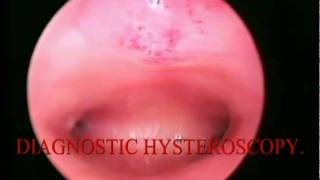 DIAGNOSTIC HYSTEOSCOPY منظار الرحم التشخيصى ED [upl. by Justina]