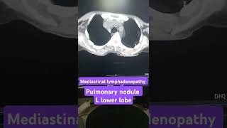 Mediastinal lymphadenopathy on CT scan pulmonary nodule on CT scan [upl. by Doownyl]