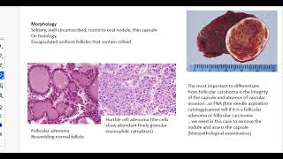 34  Endocrine  Pathology   Pathology of anterior and posterior Pituitary Gland part 2 [upl. by Pryce]