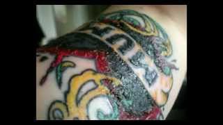 INFECTED TATTOOS WITH THICK SCABS [upl. by Proud]