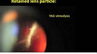 YAG vitreolysis for retained lens particle after cataract surgery [upl. by Nauqes]