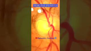 Normal fundus  Normal Retina  Smartphone Fundus Videography  Fundus Photography  Short Video 176 [upl. by Ahsinroc864]