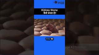 How kidney stones are formed  Kidney stone treatment  RIRS shorts [upl. by Blithe]