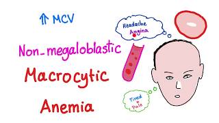 Nonmegaloblastic Macrocytic Anemia [upl. by Drexler]