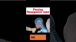 Nasogastric tube insertion 🤢🩺 shorts health [upl. by Monarski]