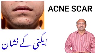 Types Of Acne Scars How Acne Scars Are Managed  Acne Nishan Ka Ilaj  Face Kay Nishan  Dr afzal [upl. by Doowle344]