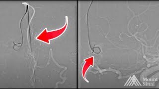 Anterior Ethmoidal Fistula Transvenous Balloon Assisted Approach [upl. by Gunner609]