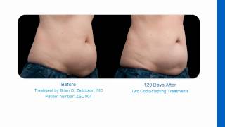 CoolSculpting Slides Irvine CA [upl. by Haikezeh]