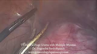 TLH for a huge uterus with multiple myomas [upl. by Ricki]