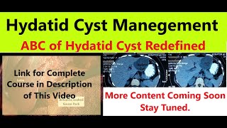 Hydatid Cyst Liver amp Cystobiliary Communication Trailer RouxenY Cystojejunostomy Video 11 [upl. by Enileuqcaj]