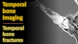 Temporal Bone Imaging  Temporal Bone Fractures [upl. by Wesle189]