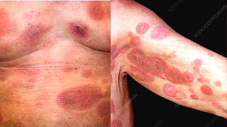 What is Mycosis Fungoides Symptoms Causes Treatment Diagnosis Cutaneous T Cell Lymphoma [upl. by Charbonnier]