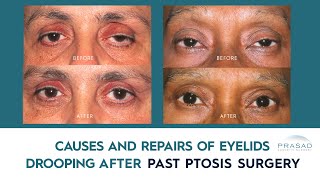 Various Causes of Eyelids Drooping after Past Ptosis Surgery and How they can be Addressed [upl. by Bowman]